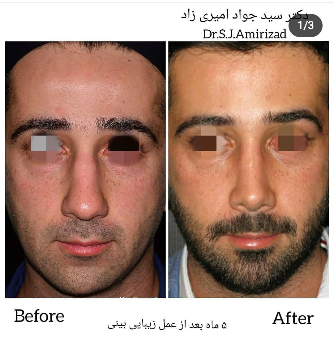 نمونه عمل بینی دکتر سید جواد امیری زاد