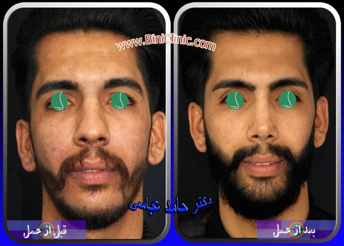 نمونه عمل بینی دکتر حامد عباسی