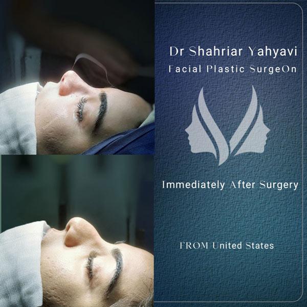 نمونه عمل بینی دکتر شهریار یحیوی
