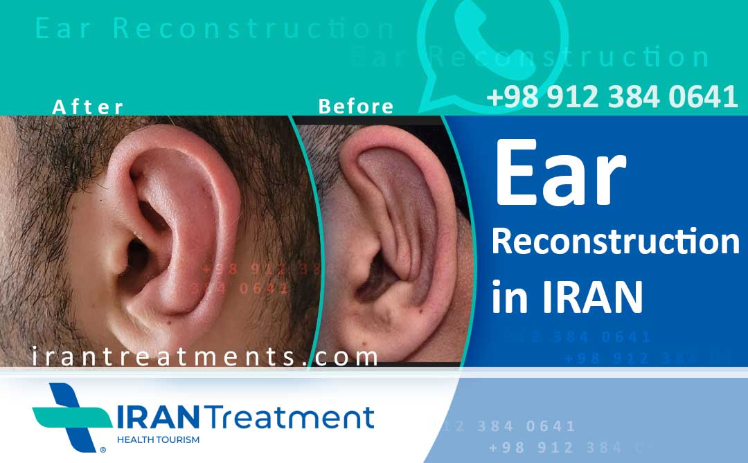 عمل جراحی بازسازی گوش در ایران